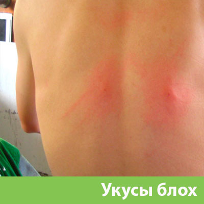 Укусы блох в Тамбове