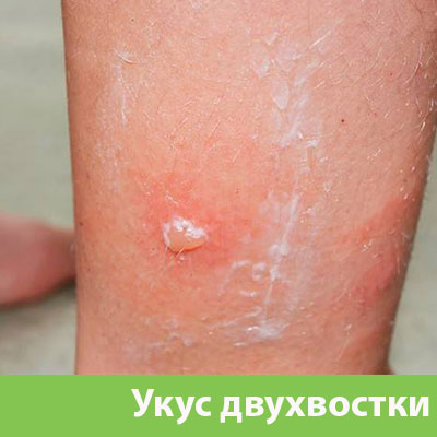 Укус двухвостки в Тамбове