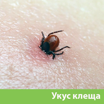 Укус клеща в Тамбове