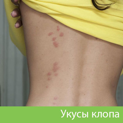Профессиональное уничтожение клопов в Тамбове